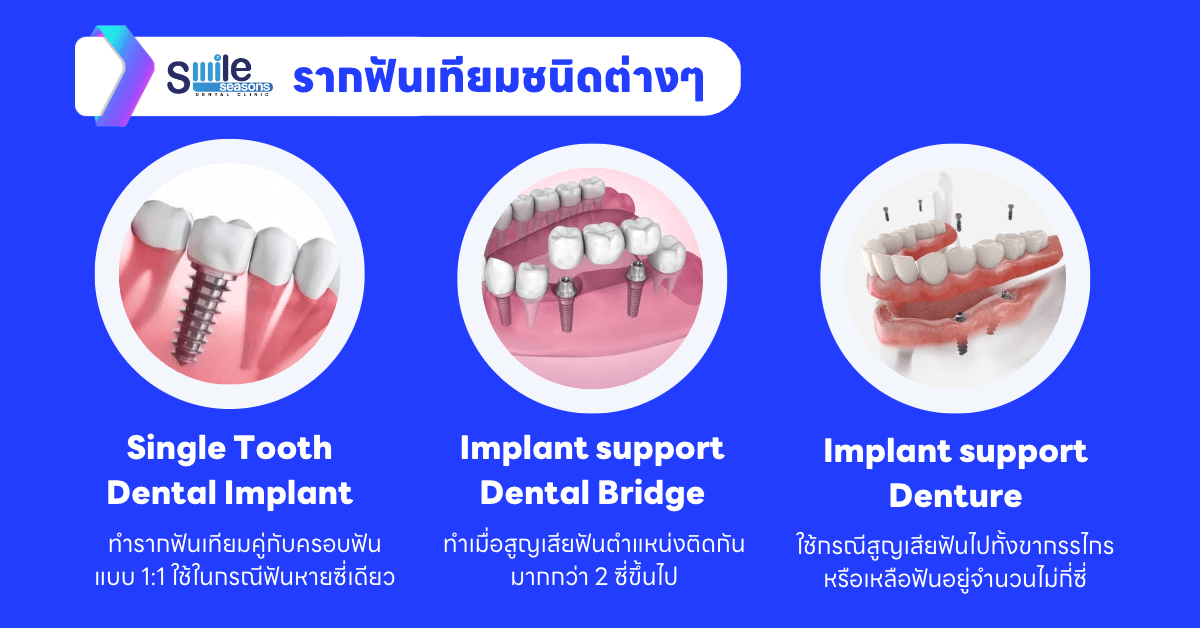 เจาะลึก รากฟันเทียมคืออะไร ราคาเท่าไหร่ ทำรากฟันเทียมเจ็บไหม