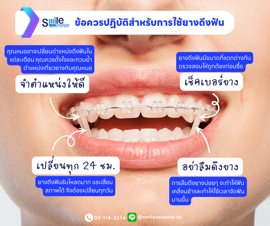 ไขข้อสงสัย ยางจัดฟัน จัดฟันแบบใส่เชน คืออะไร มีทั้งหมดกี่แบบ ? - Smile  Seasons Dental Clinic