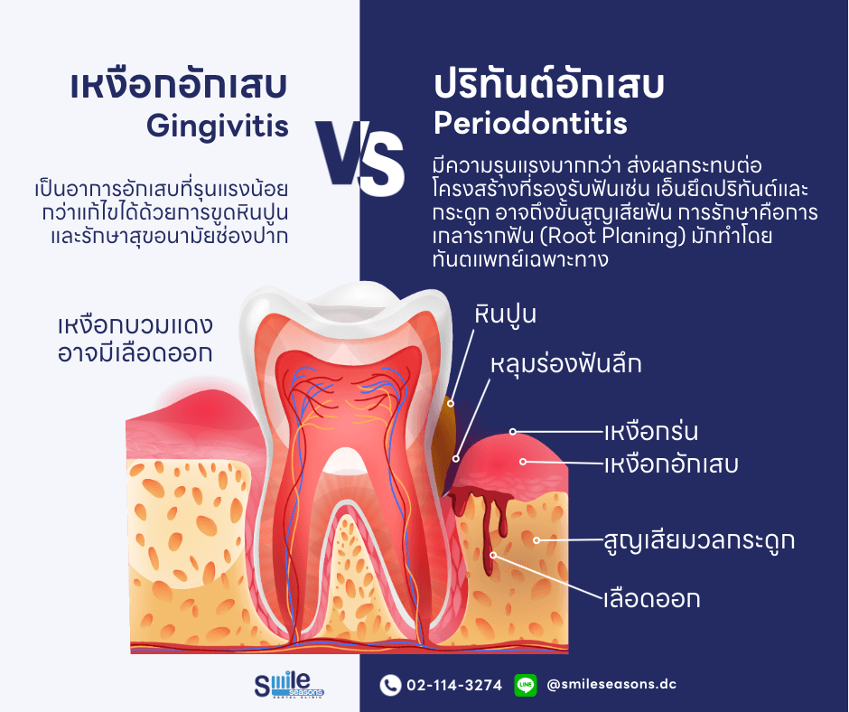 เจาะลึก! สาเหตุ เหงือกบวมแดง เหงือกอักเสบ พร้อมแนะนำวิธีรักษา - Smile  Seasons Dental Clinic