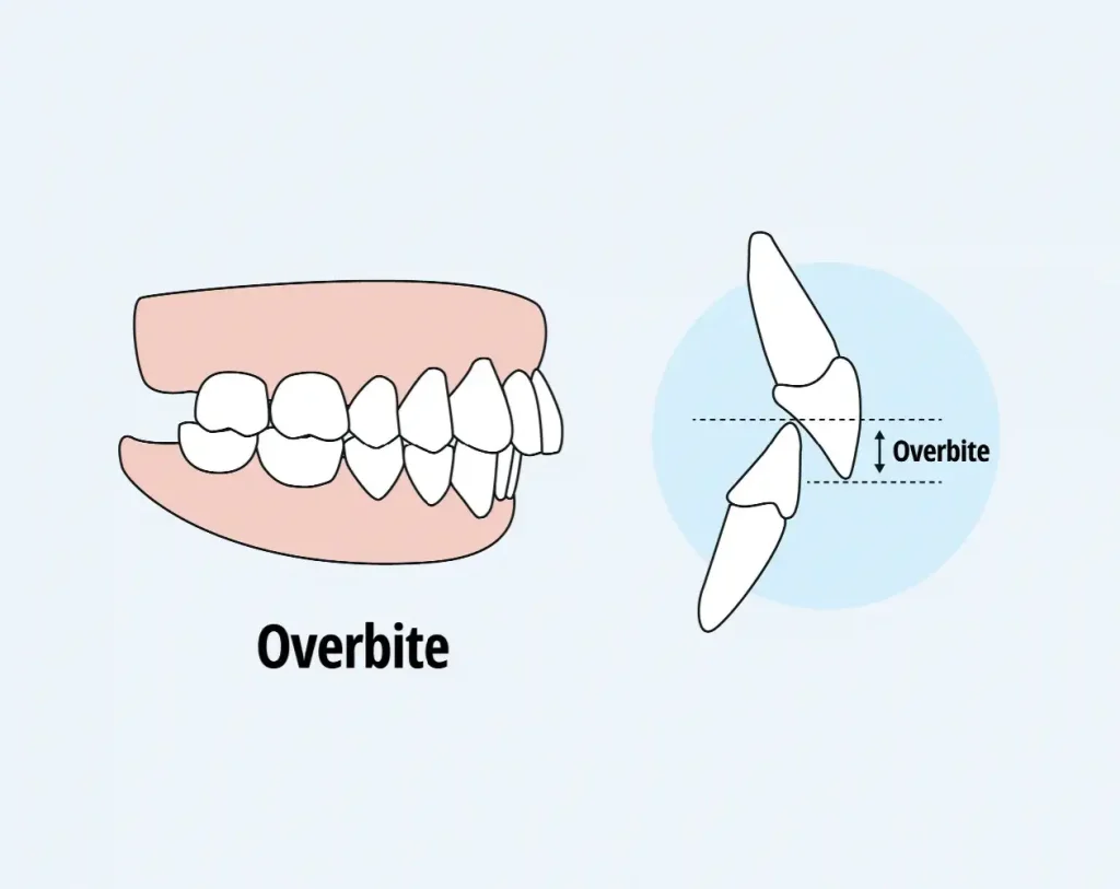 Overjet vs. Overbite: What's the Difference?